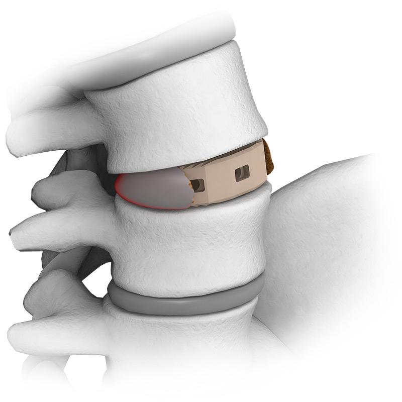 Кейдж міжхребцевий шийний опуклий PEEK 13х11х10